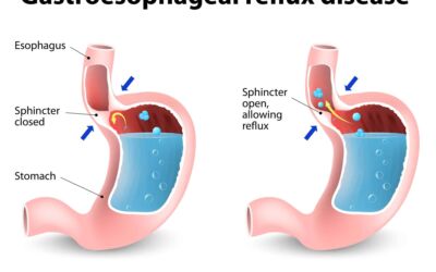 bigstock-Gastroesophageal-Reflux-Diseas